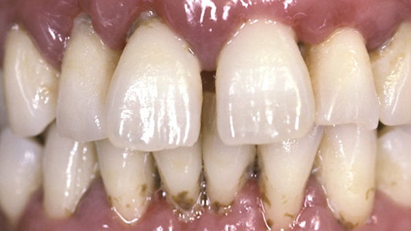 PennDental periodontitisx600