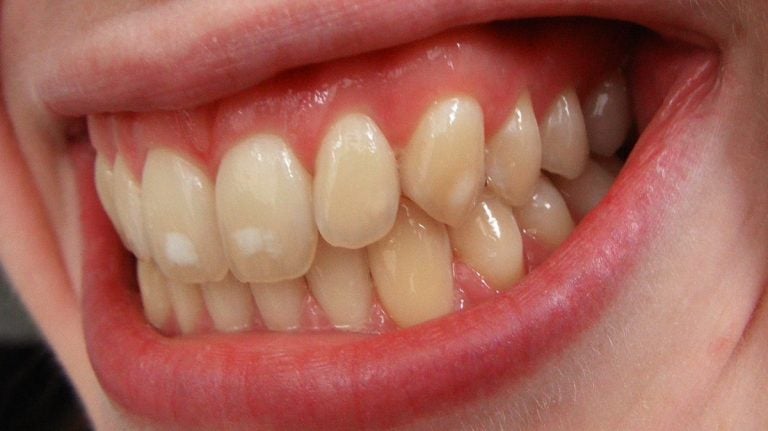 Too much fluoride can create a condition called fluorosis—white spots on the teeth. By josconklin (Own work) [<a href=