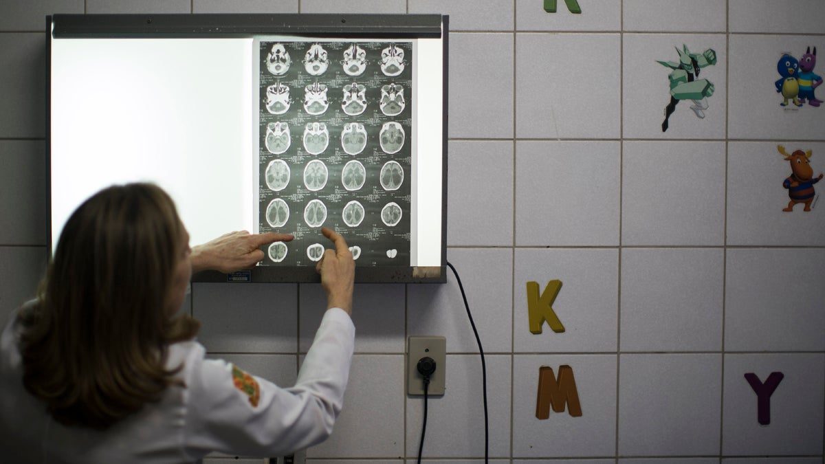  Dr. Angela Rocha shows brain scans of a baby born with microcephaly at the Oswaldo Cruz Hospital in Recife, Brazil. Brazilian officials still say they believe there's a sharp increase in cases of microcephaly and strongly suspect the Zika virus, which first appeared in the country last year, is to blame. The concern is strong enough that the U.S. Centers for Disease Control and Prevention this month warned pregnant women to reconsider visits to areas where Zika is present. (Felipe Dana/AP Photo)  