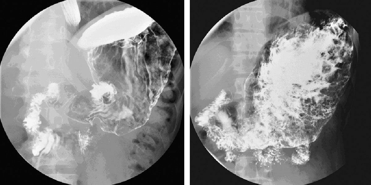  Barium enhanced X-ray of the stomach of a 35-year-old male world-class competitive speed eater before (left) and after  (right) he’s eaten 36 hot dogs in 10 minutes (Image reprinted with permission from the American Journal of Roentgenology) 