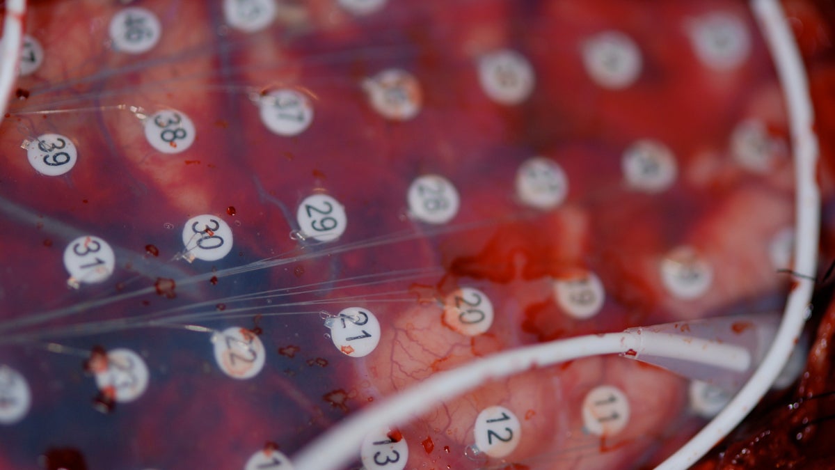  The exposed brain of one of Dr. Gordon Baltuch's epilepsy patients with a subdural grid. The numbers provide a way to determine which parts of the brain seizures come from, and can mark places where physicians might want to selectively stimulate the brain. (Image courtesy of Gordon Baltuch/University of Pennsylvania) 