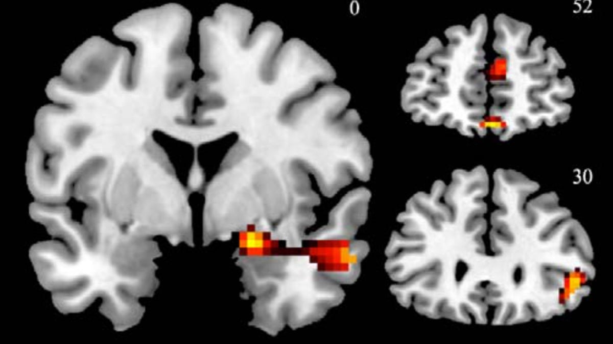 This fMRI image shows activations in the brain