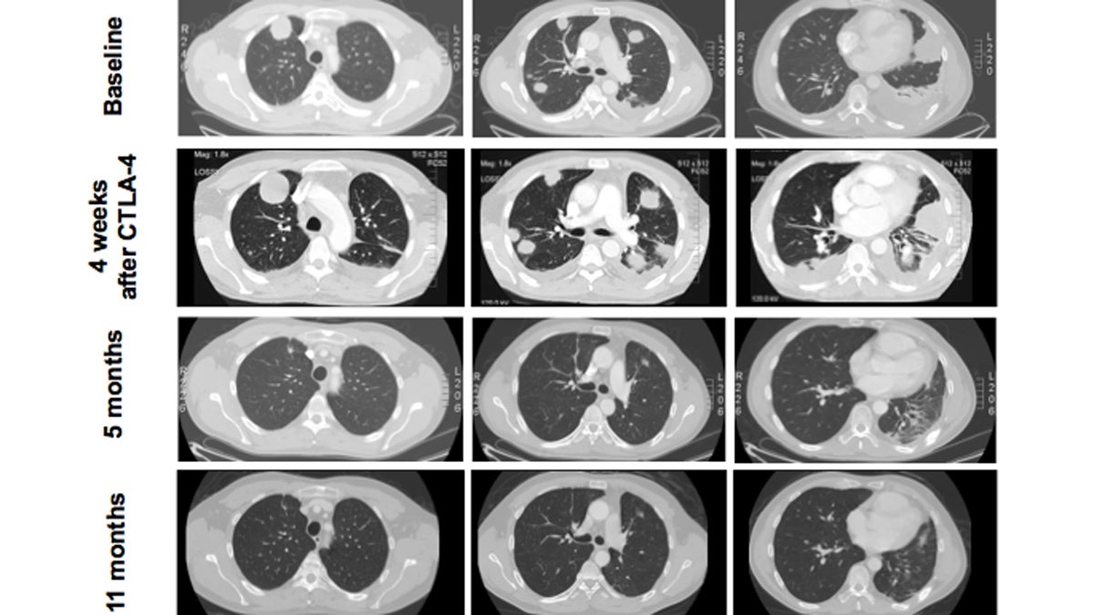 CT scans of David Bolgiano's lungs: At the time of his immunotherapy treatment (first row)
