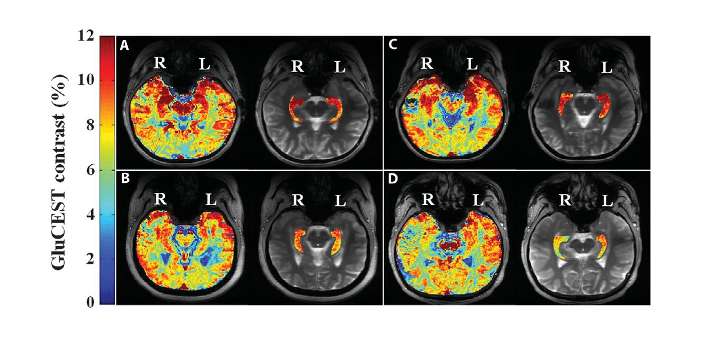  Brain sections from four patients with drug-resistant epilepsy showing the glutamate-imaging signal. (Image courtesy Davis et al., Science Translational Medicine 2015) 