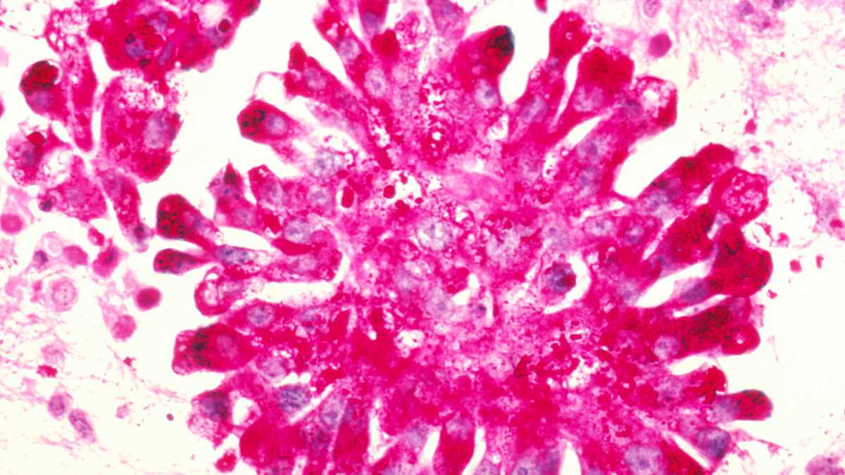  This slide from the Dr. Lance Liotta Laboratory shows Ewing's sarcoma, a form of bone cancer. The pink color is the result of a stain. (Photo via the National Cancer Institute) 