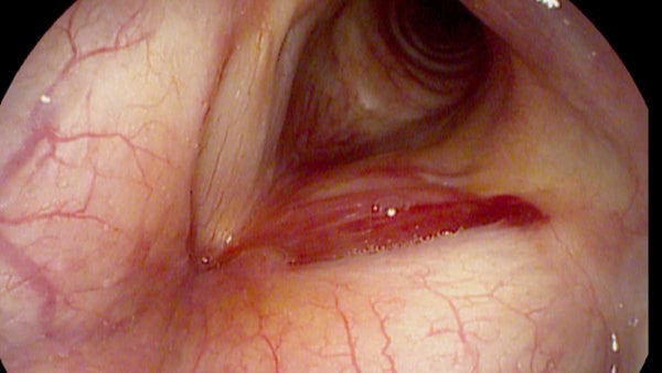 Acute vocal fold hemorrhage in a young