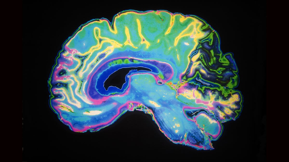 An artificially colored MRI scan of a human brain. (<a href=