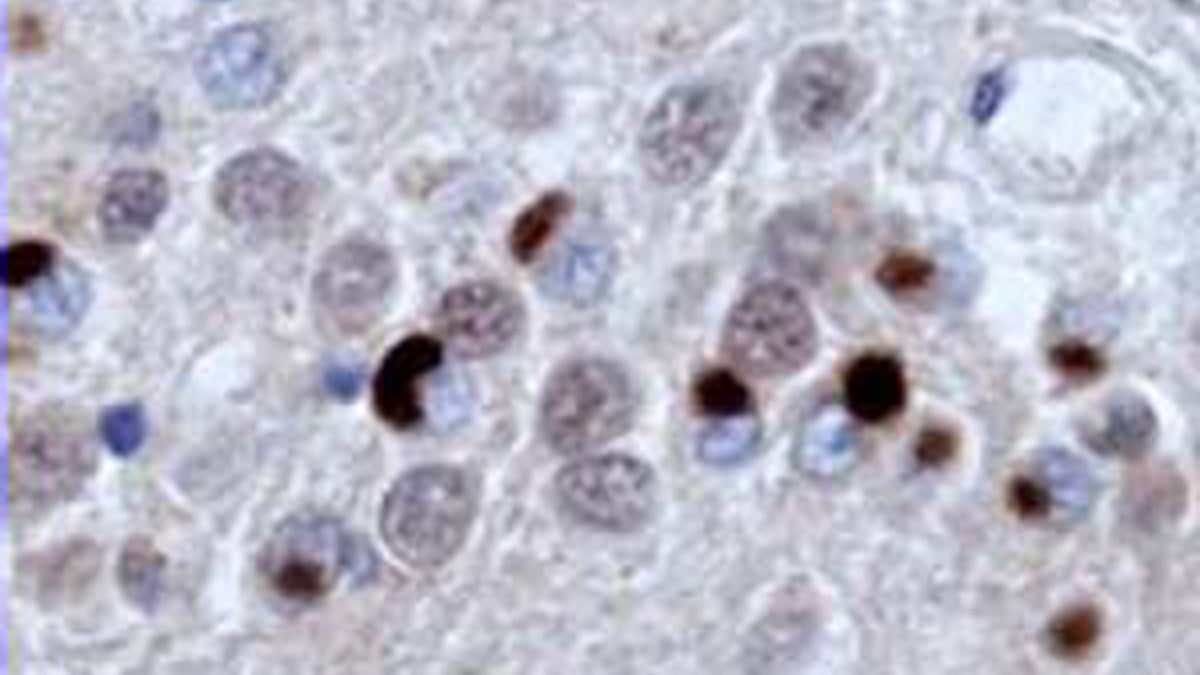  Misfolded disease proteins (deep red) in the brain of someone with  frontotemporal dementia (FTD). It is also seen in patients with amyotrophic lateral sclerosis (ALS, also known as Lou Gehrig’s disease). Certain forms of FTD, ALS and possibly other neurological diseases may involve this misfolded protein.(Image courtesy of National Institutes of Health/nih.gov) 