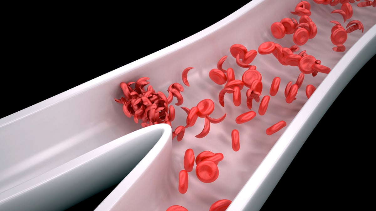  Sickle cell disease results from a mutation in hemoglobin — the protein that carries oxygen in the blood — that causes red blood cells to be crescent-shaped.(Shutterstock) 