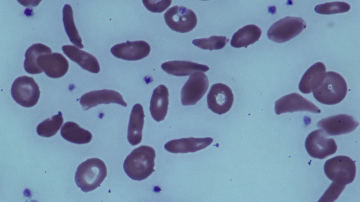 This June 2014 image provided by the National Institutes of Health, shows red blood cells in a patient with sickle cell disease at the National Institutes of Health Clinical Center in Bethesda, Md. A small but promising government study by National Institutes of Health found that bone marrow transplants can reverse severe sickle cell disease in adults. Results were published Tuesday, July 1, 2014, in the Journal of the American Medical Association. (AP Photo/National Institutes of Health) 