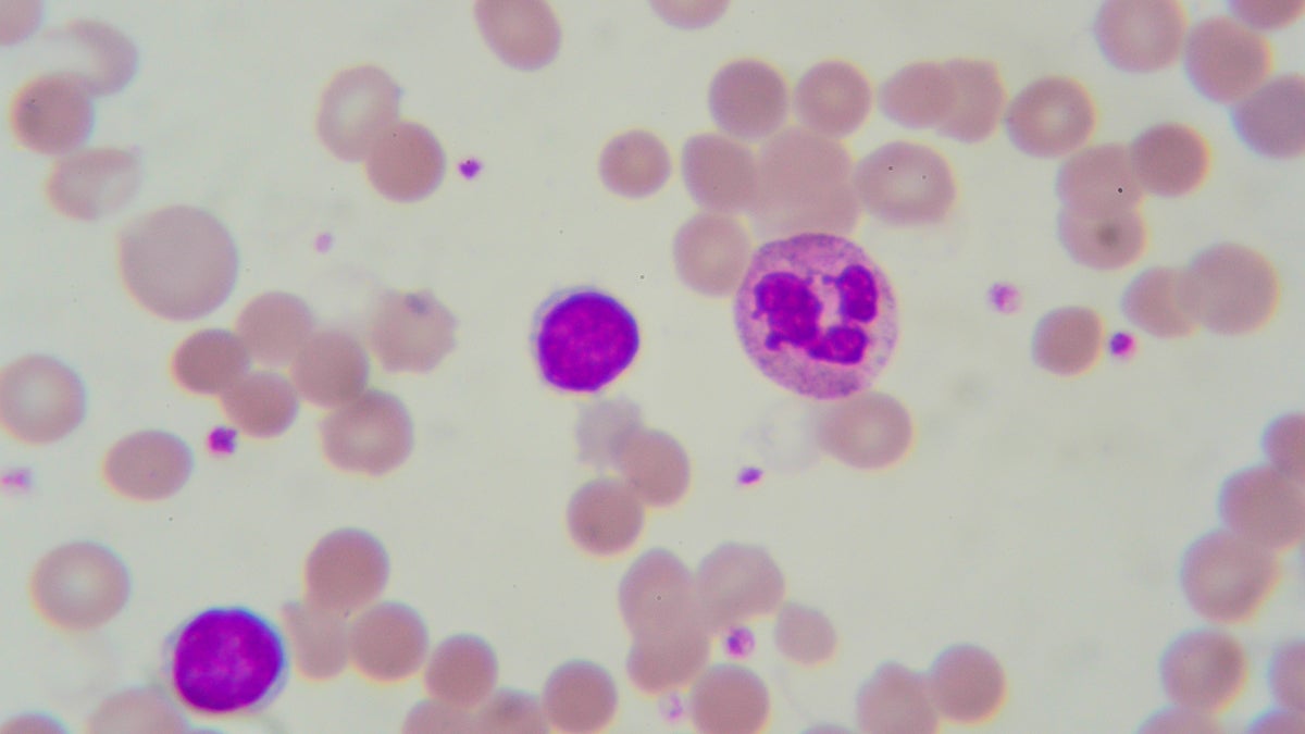  A blood smear with Neutrophil and Lymphocyte leukemia, magnified 1000 times under a microscope (<a href=