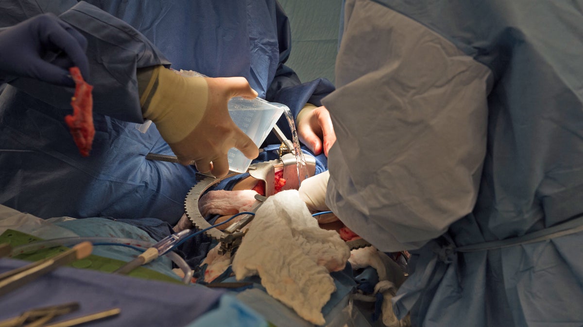  Dr. Matthew Cooper, (left) and  Dr. Seyed Ghasemian transplant a donated kidney into Brenda Hudson at MedStar Georgetown University Hospital in Washington, Tuesday, June 28, 2016.  More than 120,000 people are on the nation’s waiting list for an organ transplant, most of them for kidneys, and thousands die before receiving one because of a dire shortage of donors.  (Molly Riley/AP Photo) 