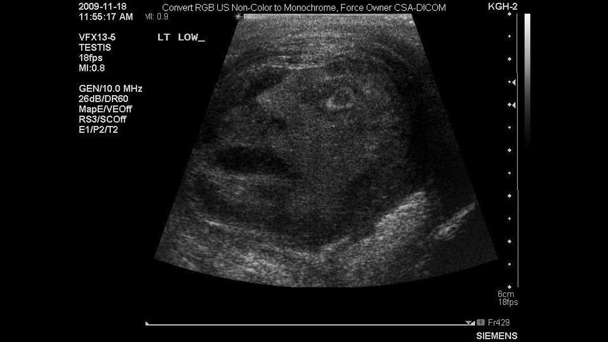  Doctors at Queen's University in Kingston, Ont., have spotted what looks like the face of a screaming man in an ultrasound of a testicular tumor.  The startling image jumped out at them while scrolling through scans of a 45-year-old patient suffering from severe testicular pain. The picture went viral after it was published in the journal 'Urology' and it's been compared to sightings of the Virgin Mary on toast or grilled cheese sandwiches. (AP Photo/Queen's University, The Canadian Press) 