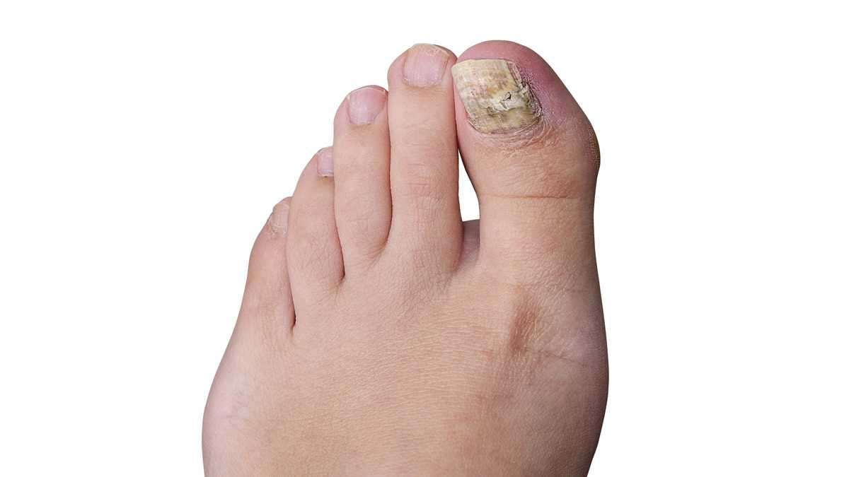If toenail fungus gets into the nail bed, the fungus eats and digests the keratin in the nail, and that causes discoloration and thickening of the nail. (Shutterstock photo) 