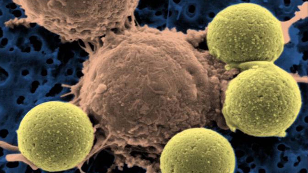  This microscopy image provided by Dr. Carl June on Wednesday, Aug. 10, 2011 shows immune system T-cells, center, binding to beads which cause the cells to divide (Dr. Carl June/AP Photo) 