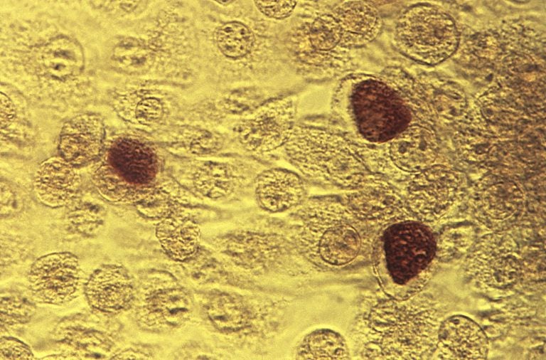 This 1975 microscope image made available by the the Centers for Disease Control and Prevention shows Chlamydia trachomatis bacteria magnified 200X.  (Dr. E. Arum, Dr. N. Jacobs/CDC via AP)