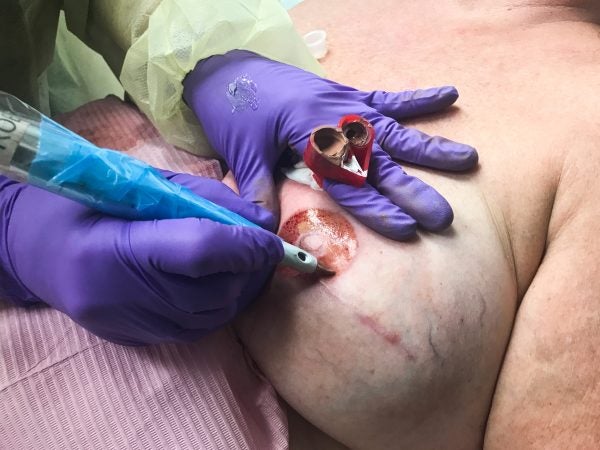 Rose Marie Beauchemin Verzella fills in Maureen Matteis-Bilbee's areola with color, tattooing in a circular motion. When she needs more ink, she dips her needle into her ring, which holds a different color in each compartment. (Abby Holtzman for WHYY) 