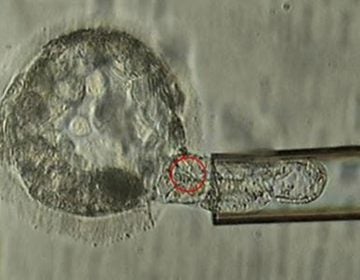 This undated microscope image provided by the American Society for Reproductive Medicine in January 2018 shows a trophectoderm biopsy, in which cells from the outer layer of an embryo that develop into the placenta and amniotic membranes are removed and can be used for genetic testing. When a couple is known to be at risk for having a child with a specific genetic disorder, the woman undergoes a procedure to remove some of her eggs. After fertilization, some cells can be plucked from the embryos and examined to identify those without carry the disease-causing abnormality. (ASRM via AP)