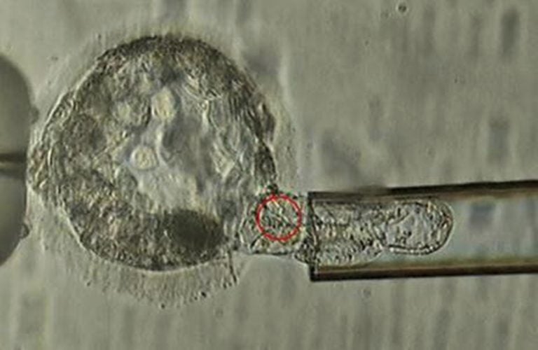 This undated microscope image provided by the American Society for Reproductive Medicine in January 2018 shows a trophectoderm biopsy, in which cells from the outer layer of an embryo that develop into the placenta and amniotic membranes are removed and can be used for genetic testing. When a couple is known to be at risk for having a child with a specific genetic disorder, the woman undergoes a procedure to remove some of her eggs. After fertilization, some cells can be plucked from the embryos and examined to identify those without carry the disease-causing abnormality. (ASRM via AP)