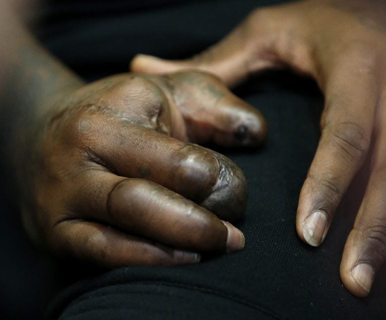 In this Oct. 30, 2015, file photo, the hand of New York Giants defensive end Jason Pierre-Paul is seen as he speaks to reporters for the first time since a fireworks injury disabled his right hand, in East Rutherford, N.J.  (Julio Cortez/AP Photo, file)