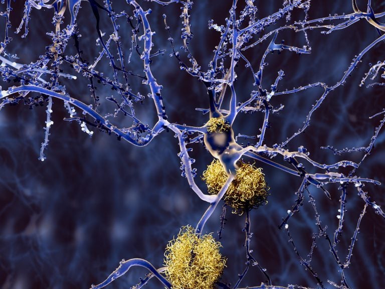 Amyloid plaques accumulate outside neurons. Amyloid plaques are characteristic features of Alzheimer's disease. (Animaxx3d/BigStock)