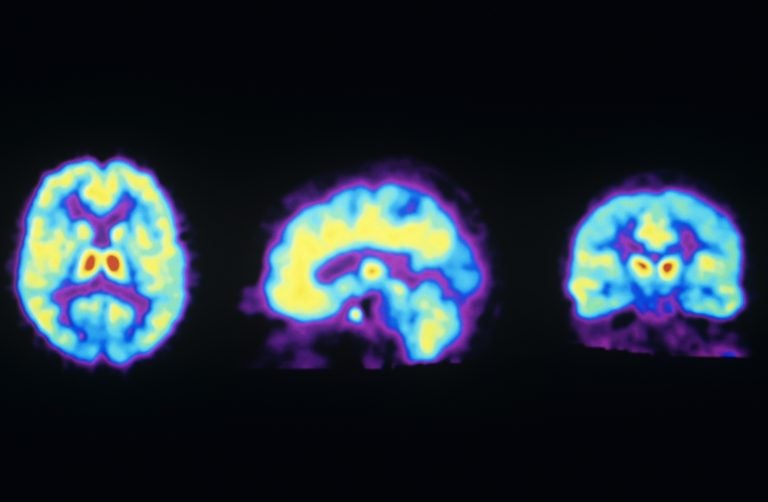 These PET scans show the normal distribution of opioid receptors in the human brain. A new study suggests ketamine may activate these receptors, raising concern it could be addictive. (Philippe Psaila/Science Source)