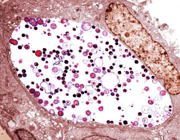 A tinted transmission electron micrograph of Chlamydia trachomatis bacteria (light purple/black) inside a cell. Chlamydia is the most common sexually transmitted disease in the U.S., with more than 1.7 million reported cases in 2017. (Biomedical Imaging Unit, Southampton General Hospital/Science Source)