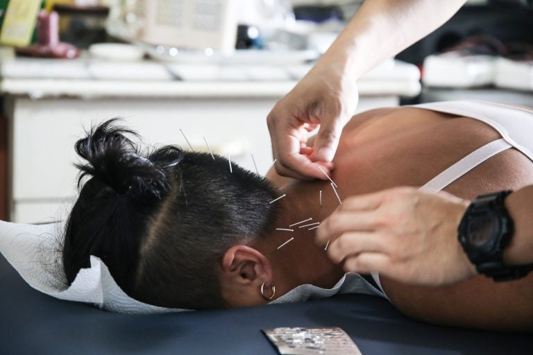 Acupuncture: real relief or theatrical placebo? - WHYY