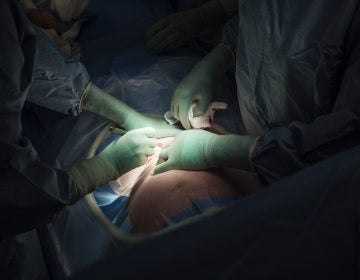 Surgeons perform a cesarean section. A new report raises concerns about rising rates of this procedure around the world, from Brazil to China. (Getty Images)