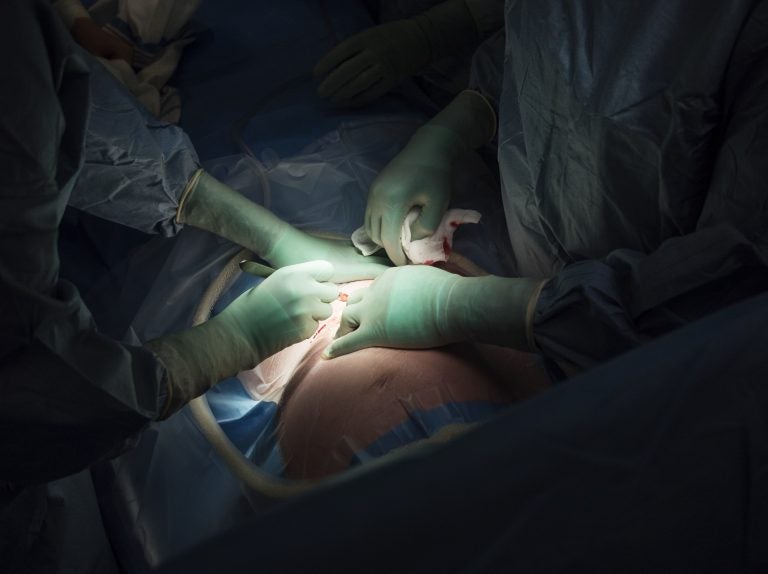 Surgeons perform a cesarean section. A new report raises concerns about rising rates of this procedure around the world, from Brazil to China. (Getty Images)