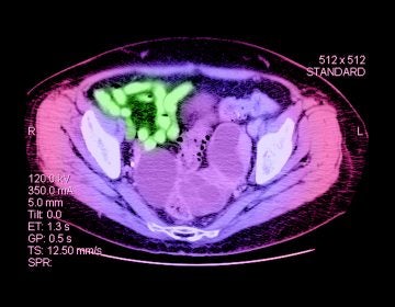 This CT scan through the pelvis shows a large cystic mass (green) which is a cystadenocarcinoma of the ovary (ovarian cancer). (Medical Body Scans/Getty Images/Science Source)