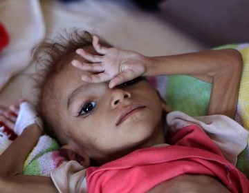 A Yemeni child suffering from malnutrition lies on a bed at a treatment center in a hospital in the capital, Sanaa. (Mohammed Huwais/Getty Images)