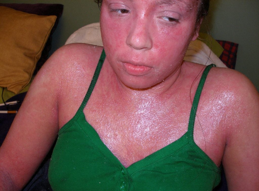 Can skin addicted to topical steroids? WHYY