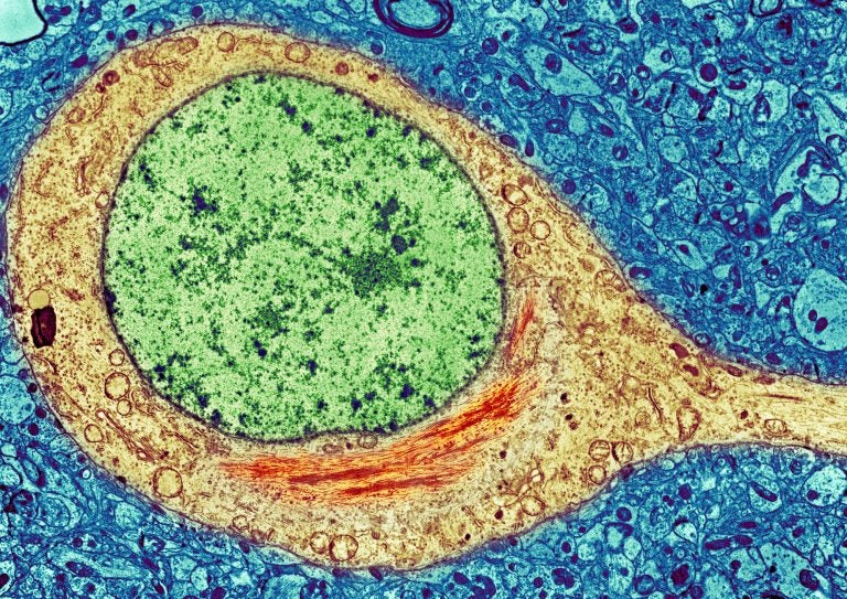 A colorized image of a brain cell from an Alzheimer's patient shows a neurofibrillary tangle (red) inside the cytoplasm (yellow) of the cell. The tangles consist primarily of a protein called tau. (SPL/Science Source)