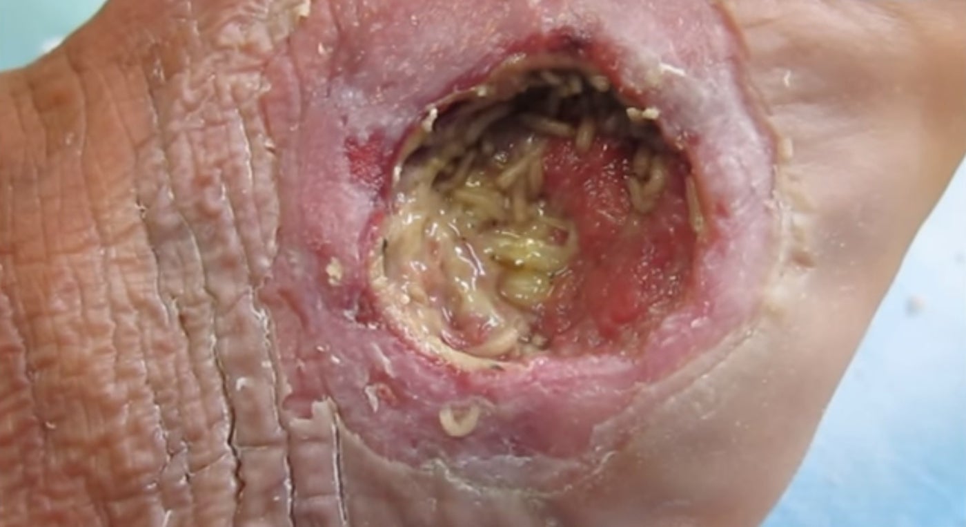 Doctors remove maggots from wounds, but could they help patients heal?