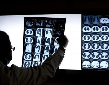 A doctor looks at the CT scan of a lung cancer patient. (Andy Wong/AP Photo)