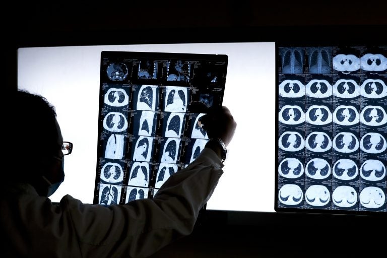 A doctor looks at the CT scan of a lung cancer patient. (Andy Wong/AP Photo)