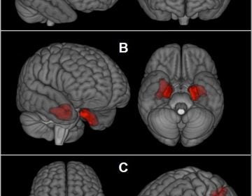 This image provided by The New England Journal of Medicine in April 2019 shows an illustration based on brain scans from former NFL players. As a group, they were found to have higher levels of an abnormal protein than a comparison group of healthy men, indicated by red patches. The protein is a hallmark of a degenerative brain disease that's been linked to repeated head blows. (The New England Journal of Medicine via AP)