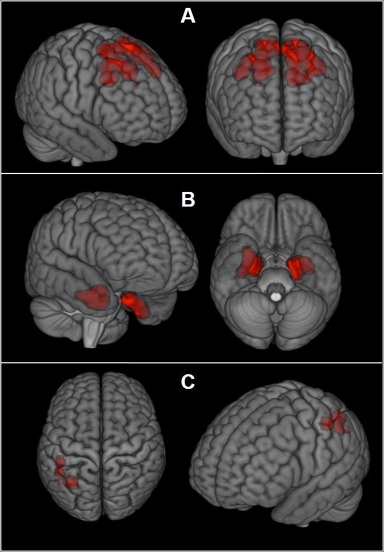 This image provided by The New England Journal of Medicine in April 2019 shows an illustration based on brain scans from former NFL players. As a group, they were found to have higher levels of an abnormal protein than a comparison group of healthy men, indicated by red patches. The protein is a hallmark of a degenerative brain disease that's been linked to repeated head blows. (The New England Journal of Medicine via AP)