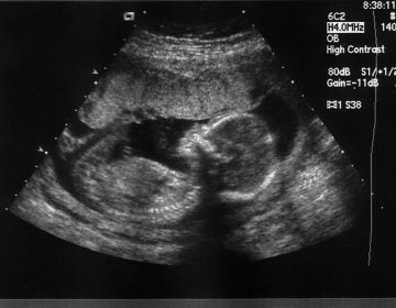Ultrasound of an 18-week fetus. (Jennifer Davis/Bigstock)