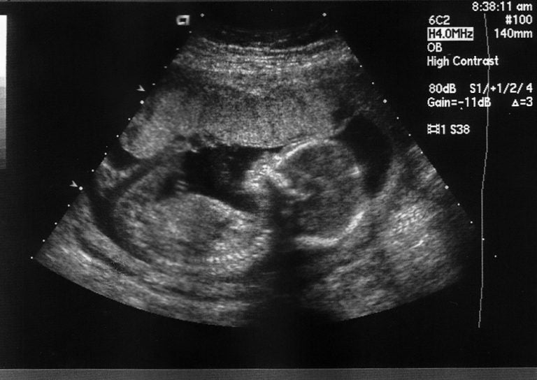 Ultrasound of an 18-week fetus. (Jennifer Davis/Bigstock)