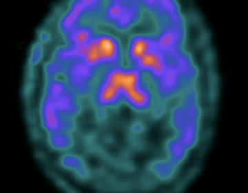 PET brain imaging of an opioid receptor binding. (Penn Medicine)
