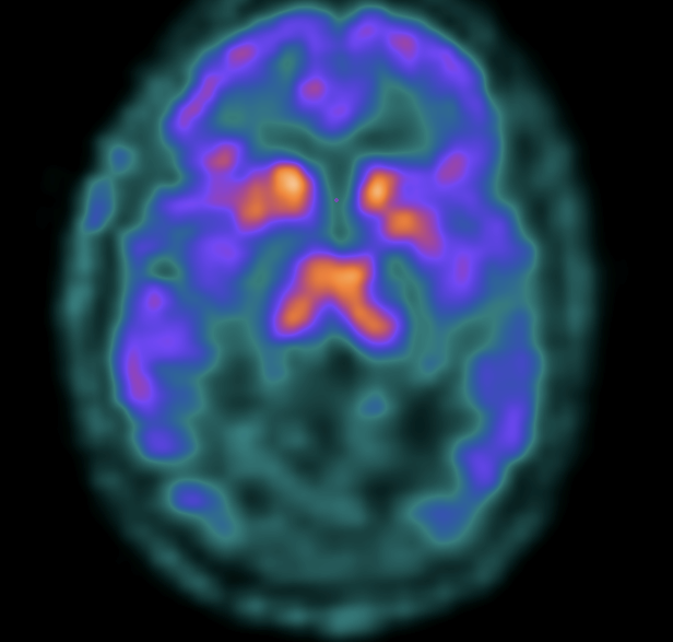 PET brain imaging of an opioid receptor binding. (Penn Medicine)
