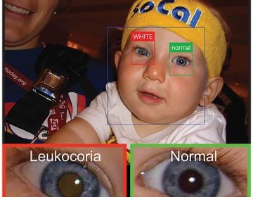 An app uses a smart phone camera to detect leukocoria, a pale reflection from the back of the eye. It can be an early sign of disease. Here it appears light brown compared the healthy eye. (Munson et al., Sci. Adv. 2019; 5 eaax 6363)