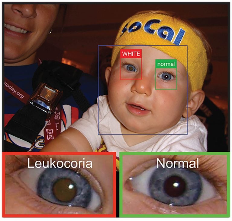 An app uses a smart phone camera to detect leukocoria, a pale reflection from the back of the eye. It can be an early sign of disease. Here it appears light brown compared the healthy eye. (Munson et al., Sci. Adv. 2019; 5 eaax 6363)