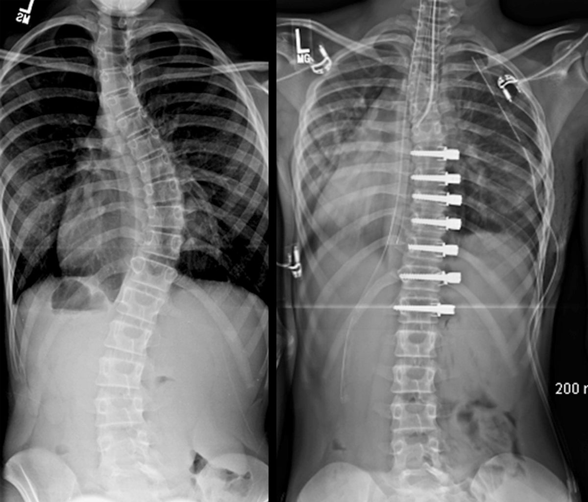 Scoliosis X Ray With Rods