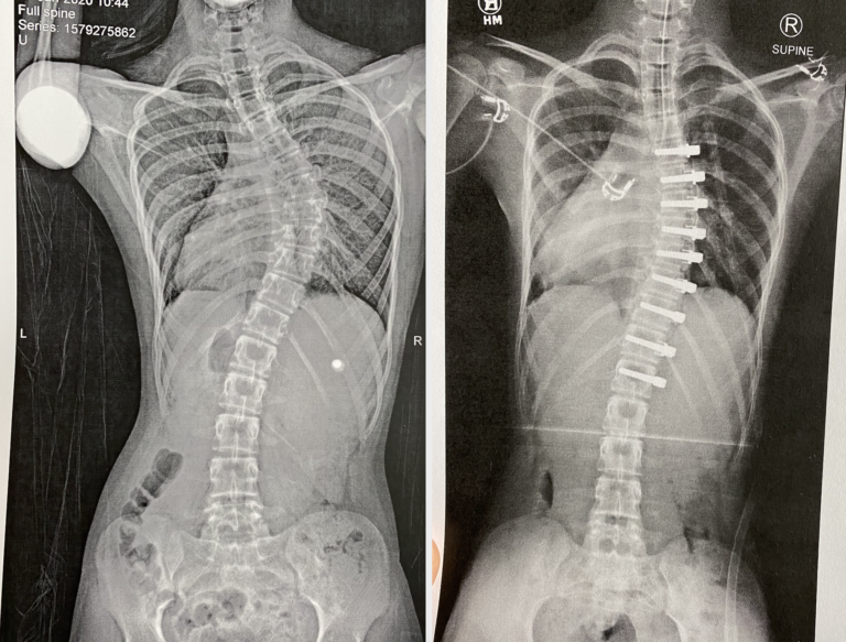 Rope or rod? Torn between scoliosis surgery WHYY