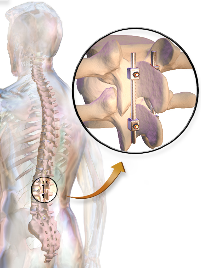 Rope Or Rod Torn Between Scoliosis Surgery Whyy