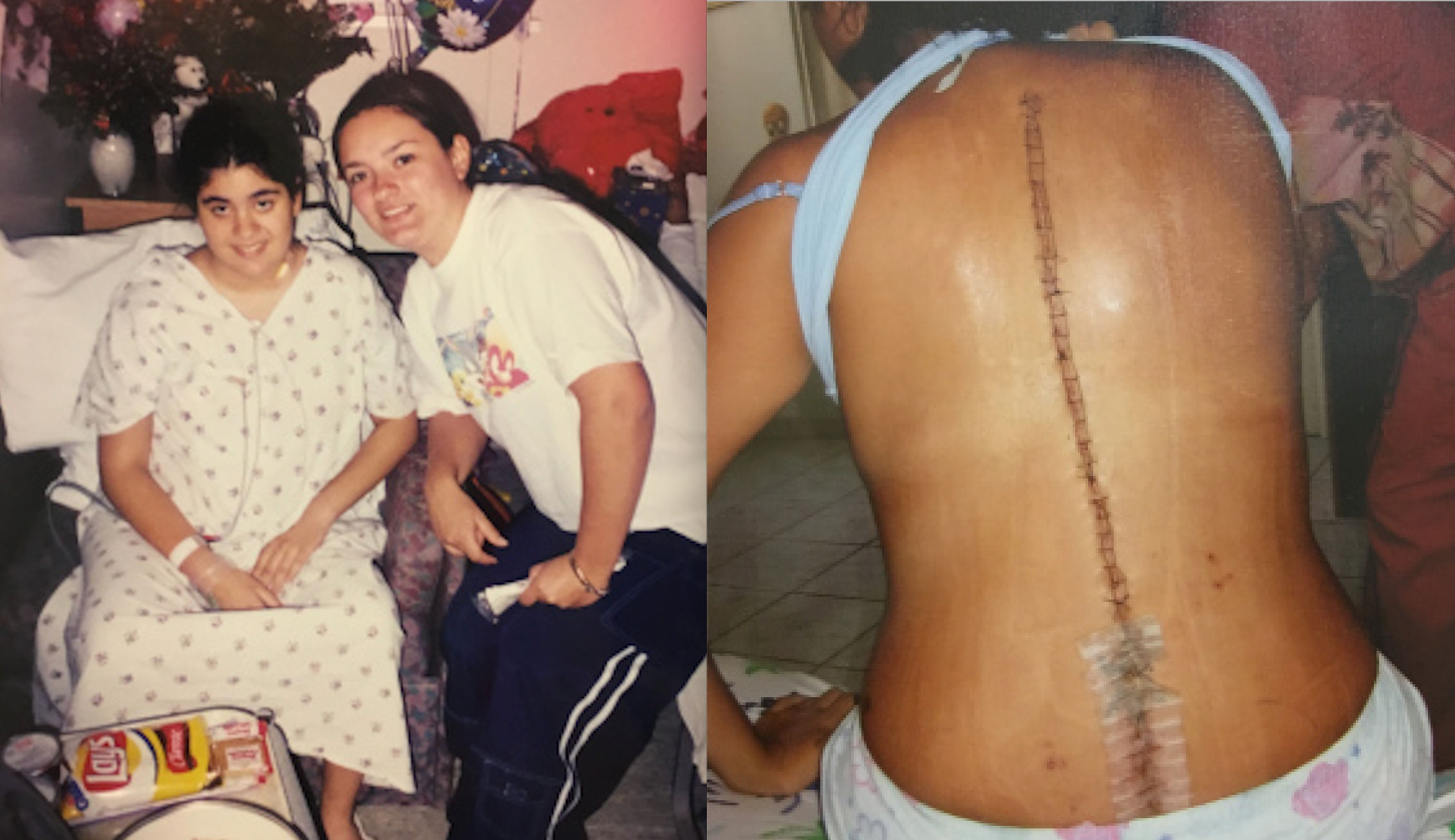 Rope or rod? Torn between scoliosis surgery - WHYY