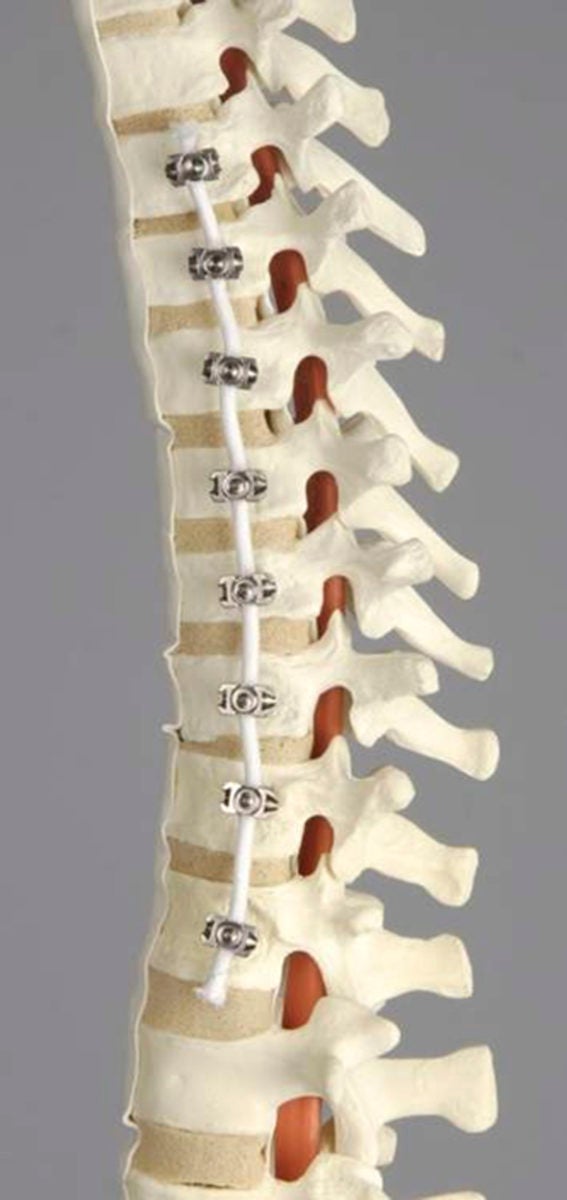 Rope or rod? Torn between scoliosis surgery WHYY